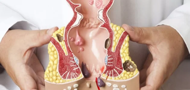 عملية البواسير في الأردن