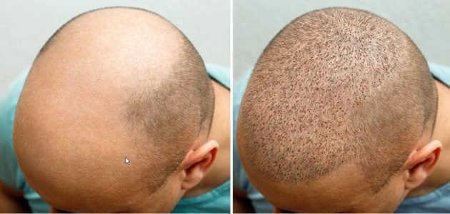 تكلفة زراعة الشعر في تركيا